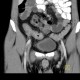 Crohn's disease of neoterminal ileum, abscess: CT - Computed tomography